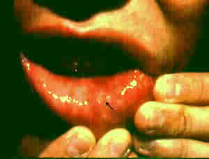 Steroids cause mouth ulcers